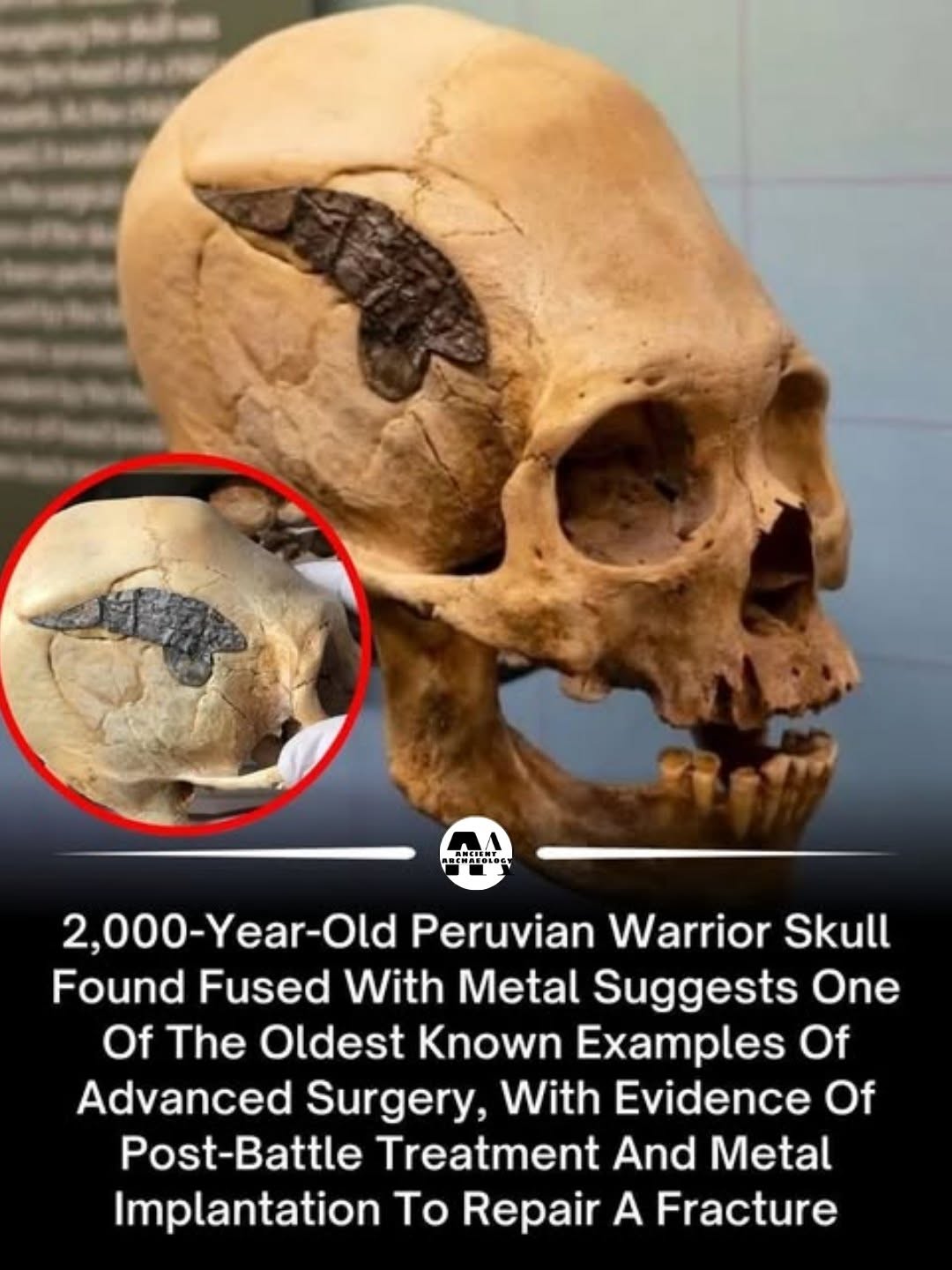 Có thể là hình ảnh về xương và văn bản cho biết '2,000-Y 2,000-Year-Old Old Peruvian Warrior Skull Found Fused With Metal Suggests One Of The Oldest Known Examples Of Advanced Surgery, With Evidence Of Post-Battle Treatment And Metal Implantation To Repair A Fracture'